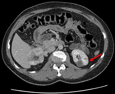 Case of Hereditary Papillary Renal Cell Carcinoma Type I in a Patient With a Germline MET Mutation in Russia